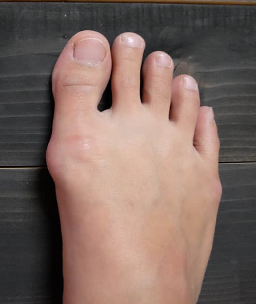 Hallux valgus, bunion in foot